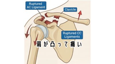 肩が凸って痛い💦